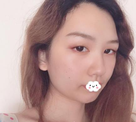 武漢伊萊美割雙眼皮怎么樣？切開(kāi)雙眼皮恢復(fù)過(guò)程圖
