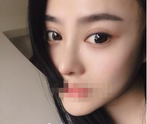 親身經(jīng)驗，重慶星范整形的超體隆鼻真的很自然