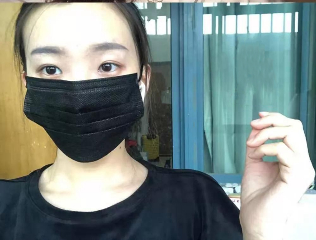 做雙眼皮案例，北京藝星張順慶雙眼皮案例圖片