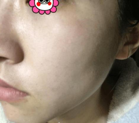 溫州韓美整形激光祛斑案例治療后一個(gè)月效果