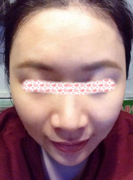 像我一樣寬鼻翼的小姐姐們可以放心找李旭平做隆鼻了，親測好評
