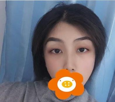 溫州韓美周杰群醫(yī)生耳軟骨隆鼻案例分享術(shù)后一個月效果