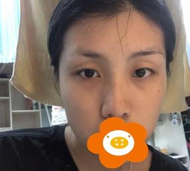 溫州韓美周杰群醫(yī)生耳軟骨隆鼻案例分享術(shù)前效果