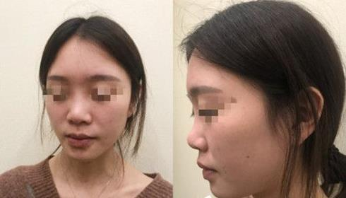 耳軟骨隆鼻術(shù)后三個月，我有了韓佳人同款美鼻