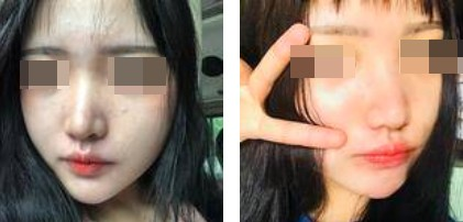 一個(gè)鼻子讓一張臉迅速高級(jí)，還不考慮做個(gè)鼻綜合嗎