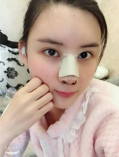這么好的效果，不來蘭州美月做膨體隆鼻真是白瞎了醫(yī)生的技術(shù)