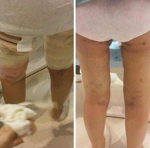 4800做的大腿吸脂，效果竟然還不錯