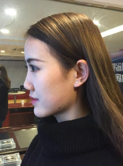 北京藝美整形鼻綜合案例分享，我都忍不住多看了兩眼