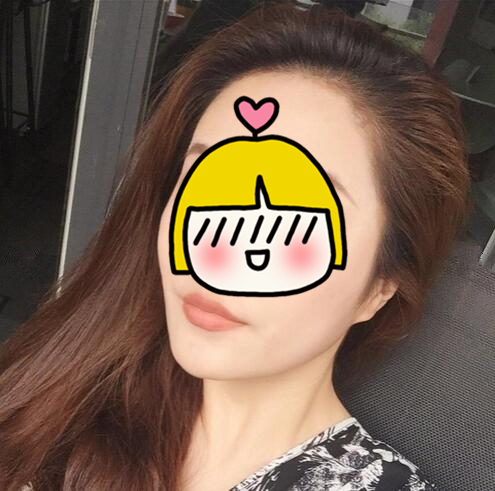 南京藝星整形趙海波面部吸脂一個月效果分享，有圖
