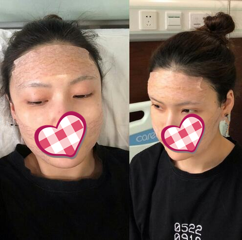 哈爾濱成美自體脂肪全臉填充案例，果然還是飽滿顯年輕