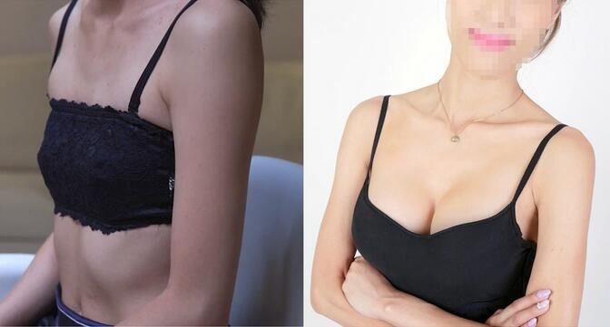 北京東方和諧整形自體脂肪隆胸案例反饋，飛機(jī)場(chǎng)女生必看