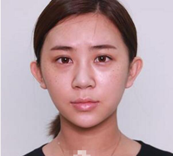深圳鵬程整形劉冰做的鼻子真絕了，跟我想象的一模一樣