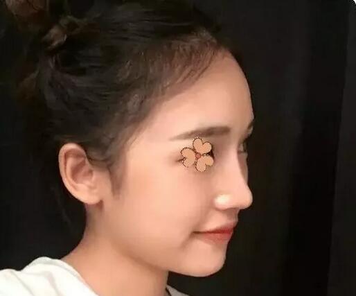 深圳福華整形陳貞宜超體隆鼻術后一個月