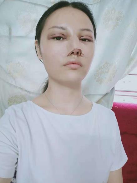 長沙雅美眼鼻整形案例術(shù)后第二天效果