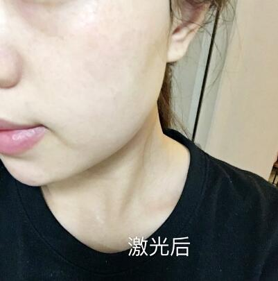 紹興維美整形激光祛斑兩個療程，皮膚像剝了殼的雞蛋