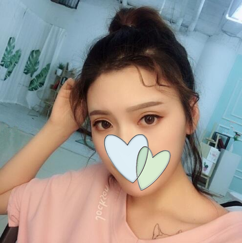 哈爾濱成美自體脂肪全臉填充案例一個(gè)月