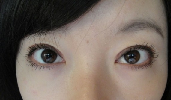 在鄭州望京做全切雙眼皮+開(kāi)外眼角，術(shù)后效果確實(shí)沒(méi)讓我失望