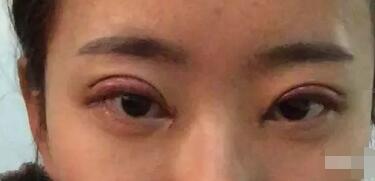 武漢藝星整形岳金堂醫(yī)生雙眼皮案例術后一周