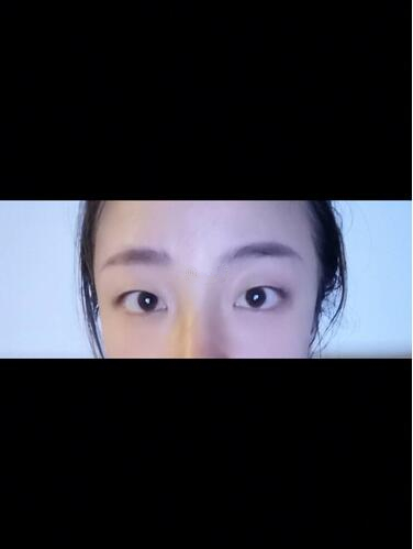 西安時(shí)光整形郭淑華雙眼皮案例分享，一個(gè)月就這么自然