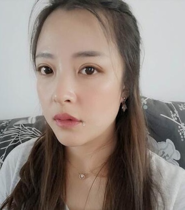 濟南韓式整形雙眼皮術(shù)后三個月