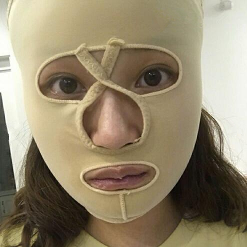 重慶美聯(lián)臣下頜角整形半個月效果