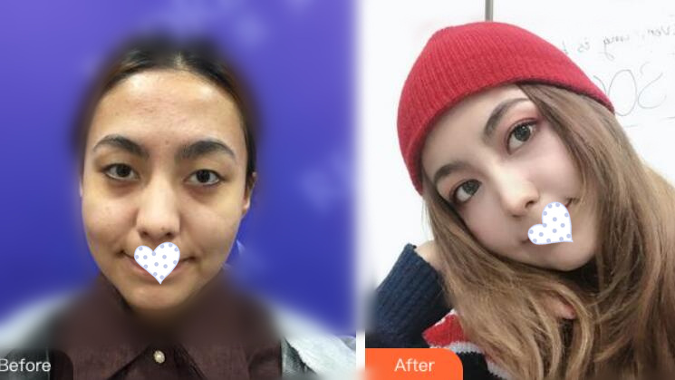 徐州時(shí)光洪揚(yáng)整形雙眼皮案例分享，好看到詞窮