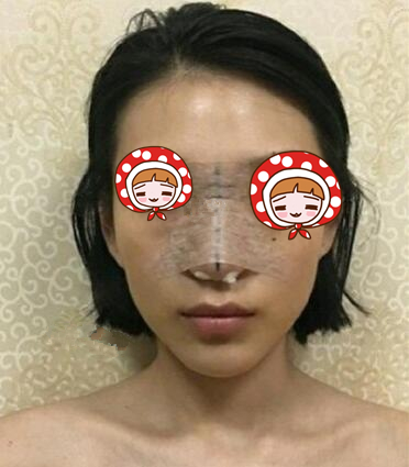 青島華諾整形歪鼻矯正術(shù)后第二天