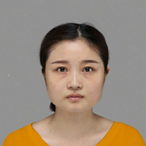 重慶美聯(lián)臣下頜角整形術(shù)后三個(gè)月效果反饋，一定要忌嘴
