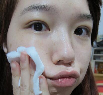 宜昌蕾帝整形張景雷雙眼皮一個(gè)多月效果