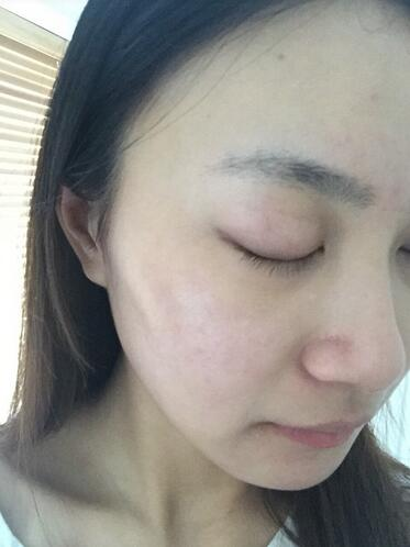 合肥艾雅整形紅藍(lán)光祛痘兩個療程效果，痘痘都消失了
