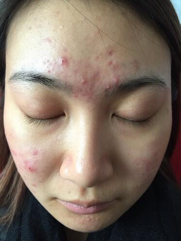 合肥艾雅整形紅藍(lán)光祛痘兩個療程效果，痘痘都消失了