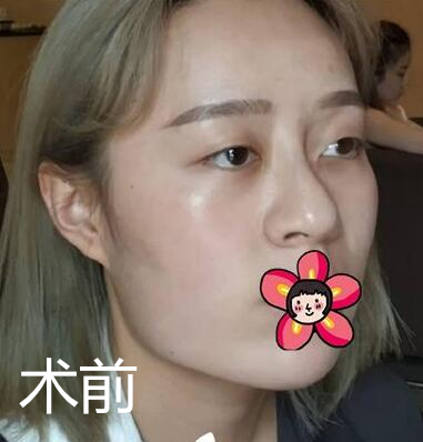 北京基礎美下頜角整形案例效果分享，黃大勇果然名不虛傳