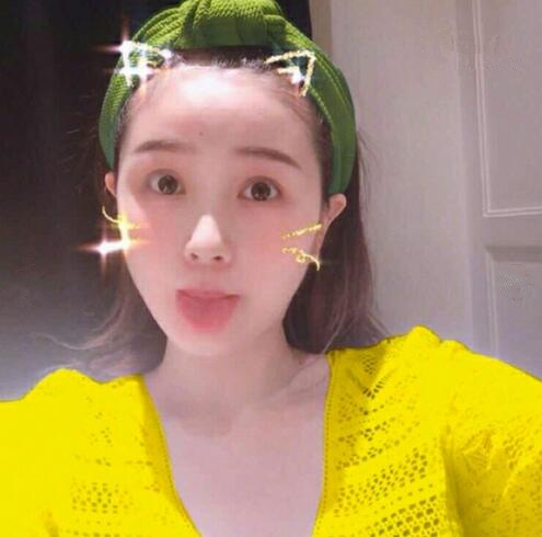 重慶美聯(lián)臣下頜角整形三個月效果