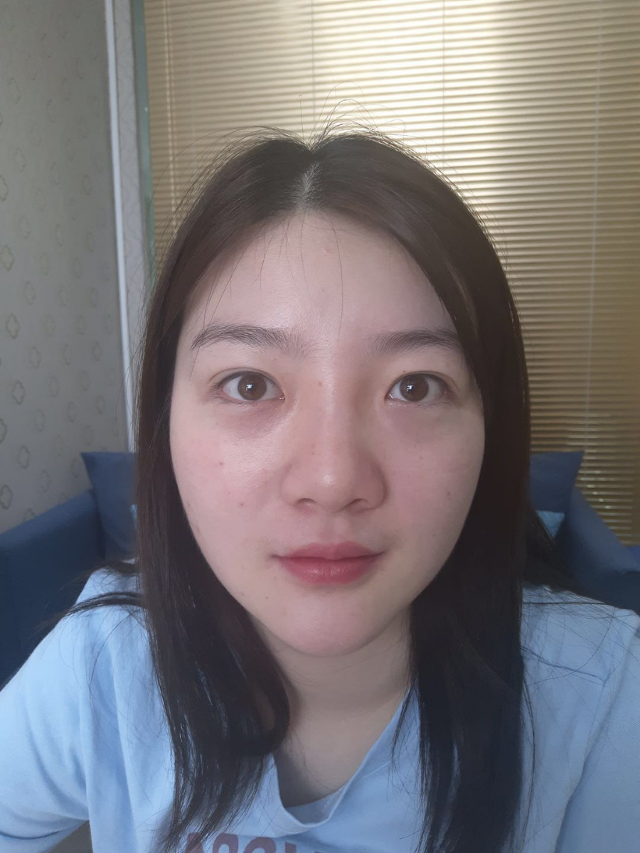 北京圣嘉榮二次鼻修復(fù)案例分享，做整形一定不要去莆田系醫(yī)院