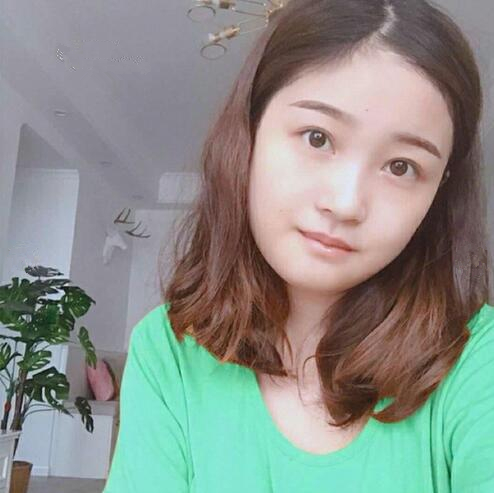 重慶美聯(lián)臣下頜角整形一個月效果