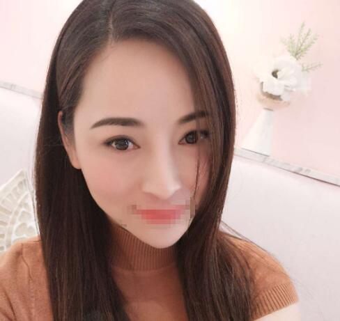 赤峰現(xiàn)代婦產(chǎn)醫(yī)院醫(yī)療美容科袁俊龍雙眼皮修復術(shù)后一個月