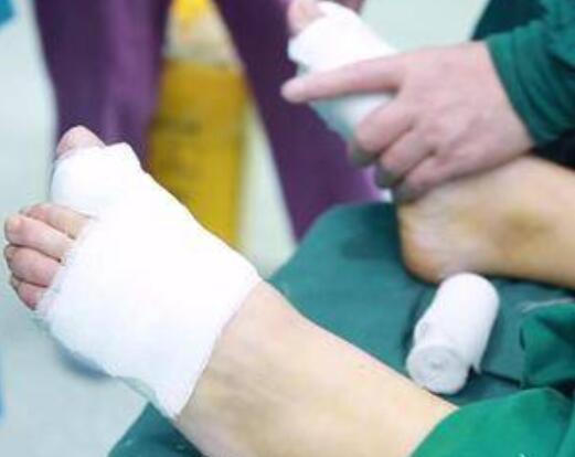 大同和平燒傷骨科醫(yī)院整形美容科大腳骨矯正術(shù)后當天