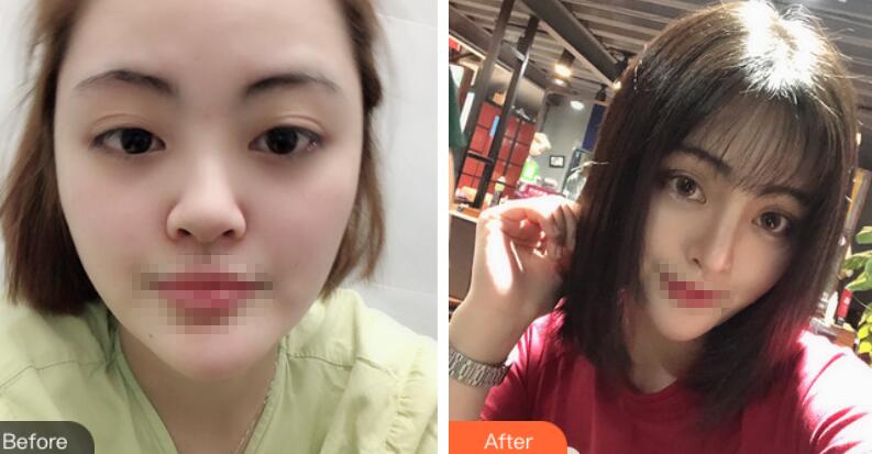 上海賽美瑞整形張化舉鼻綜合前后對比圖