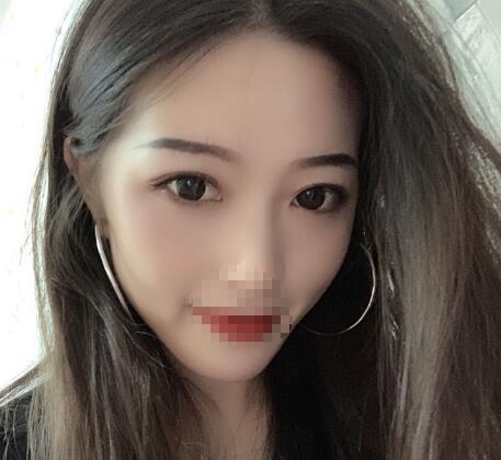 北京美萊整形杜園園雙眼皮三個(gè)月效果