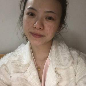 邯鄲佑熙整形孫堅激光祛斑案例分享