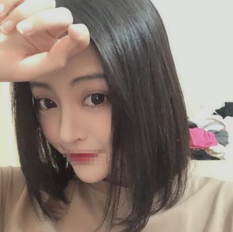 上海賽美瑞整形張化舉鼻綜合兩個月效果