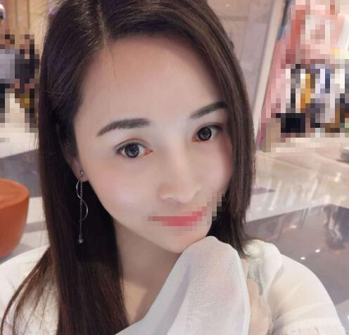 赤峰現(xiàn)代婦產醫(yī)院醫(yī)療美容科袁俊龍雙眼皮修復案例分享