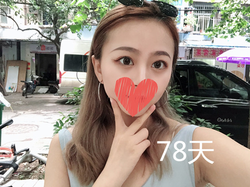 杭州靜港林忠泵埋線雙眼皮案例1-7天效果圖分享，讓你的眼睛魅力四射
