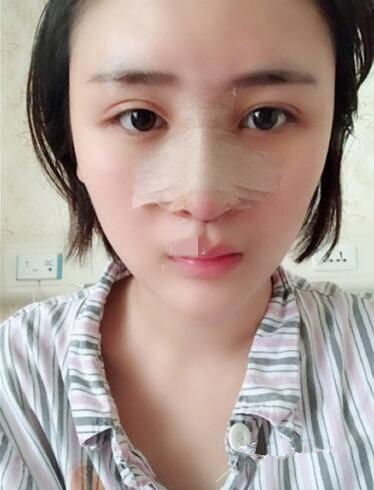 濟(jì)南鵬愛整形醫(yī)院怎么樣？濟(jì)南鵬愛王飏隆鼻案例分享