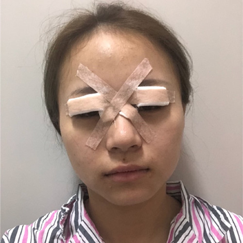杭州靜港林忠泵埋線雙眼皮案例1-7天效果圖分享，讓你的眼睛魅力四射