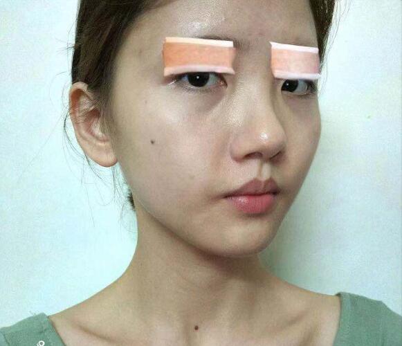 做切開雙眼皮手術(shù)之前的我