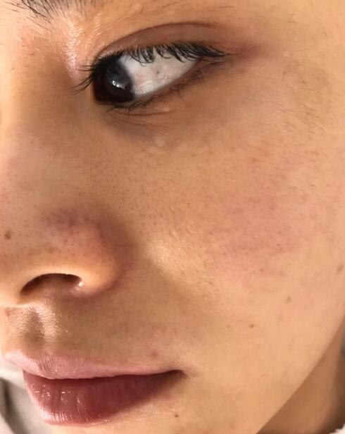 福州愛思特比華利整形林秋蓉醫(yī)生做光子嫩膚過程體驗(yàn)！皮膚Q彈