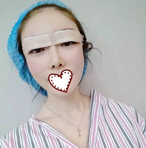 剛做完雙眼皮手術(shù)，還在恢復(fù)過程中