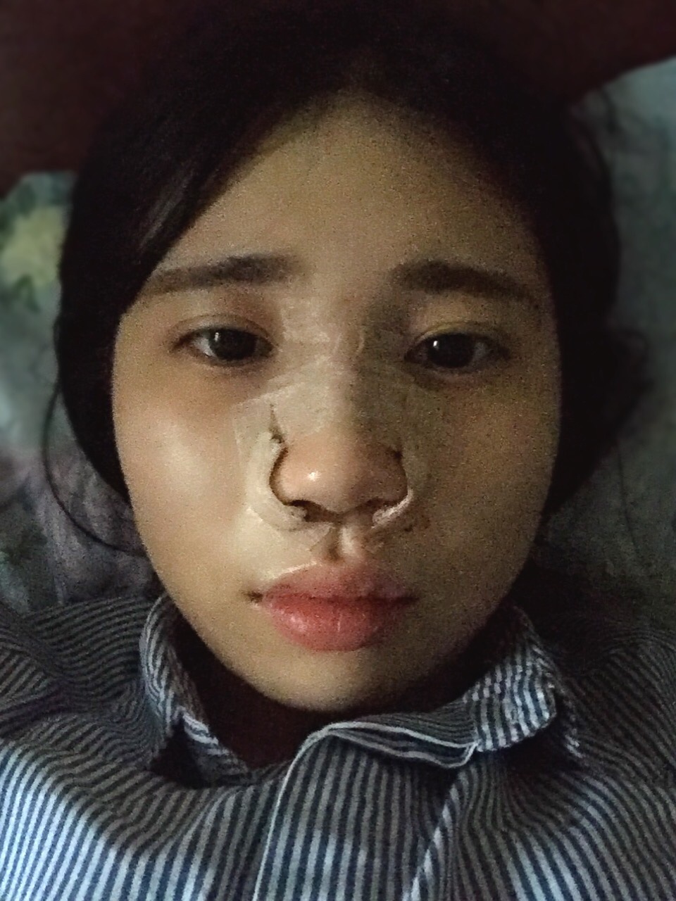 剛做完鼻骨縮窄手術(shù)時的樣子