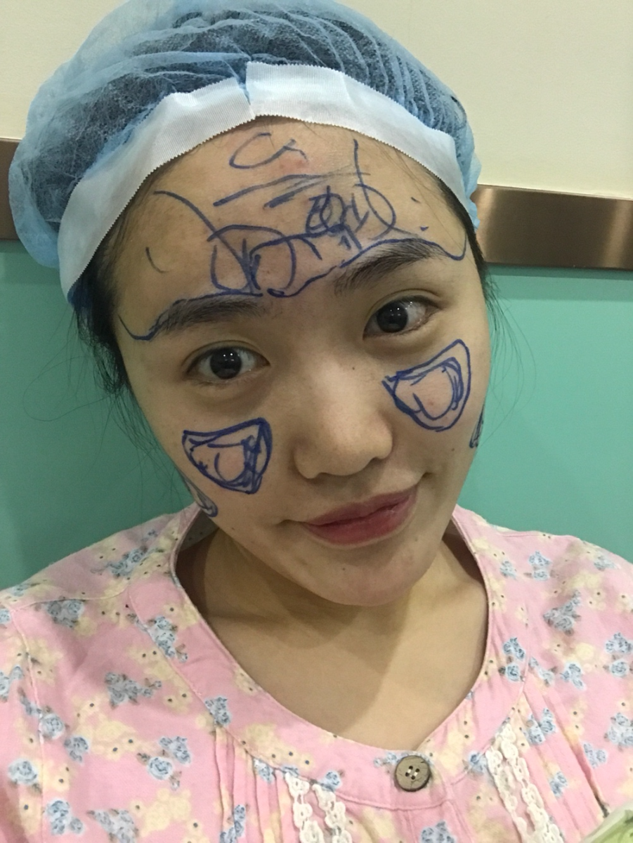 北京星美李寧輝進(jìn)口膨體隆鼻案例效果對比圖，鼻子自然又美麗